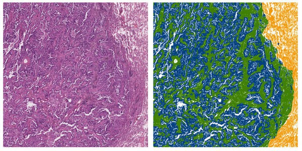 醫(yī)療病理學領域 通過語義分割技術實現(xiàn)組織切片識別效果