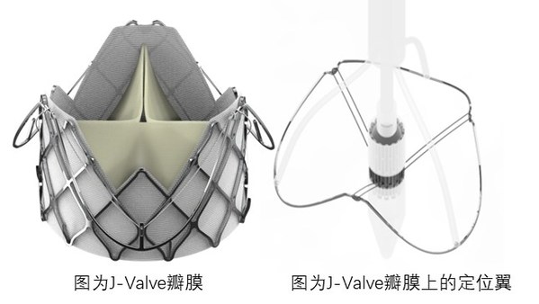 J-Valve瓣膜上的定位翼完全張開，可以找到主動脈竇并能自我調(diào)整對準(zhǔn)瓣膜植入點；杰成將這一過程命名為“自主導(dǎo)航定位系統(tǒng)”