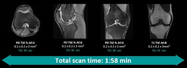 應(yīng)用Deep Resolve，超高分辨率完整膝關(guān)節(jié)掃描可在2分鐘以內(nèi)完成，并提供高信噪比圖像