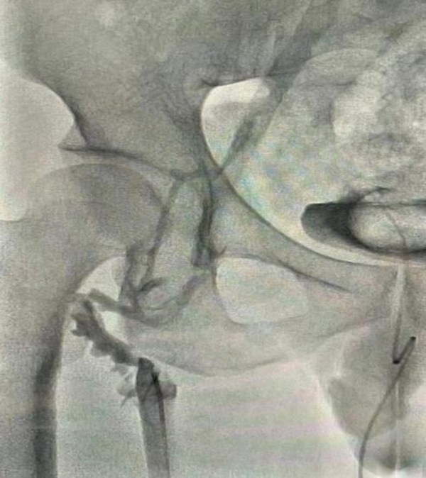 吸栓前造影顯示血栓栓塞