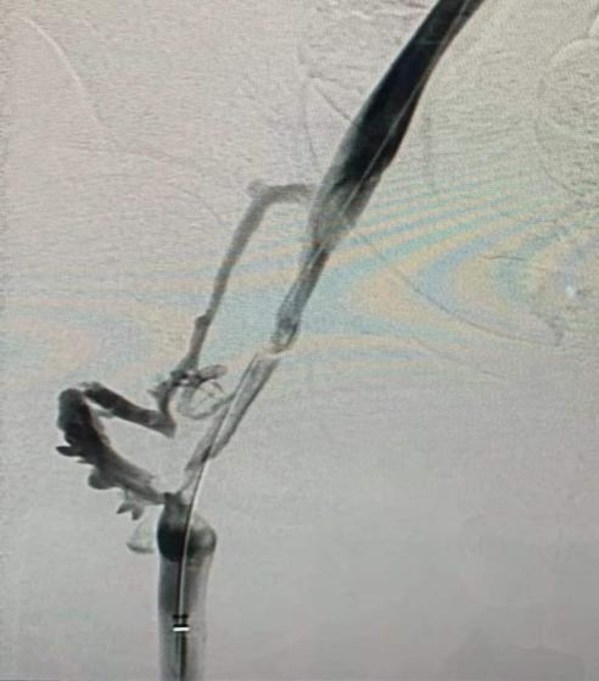 吸栓后造影顯示血流改善