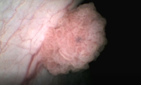 使用Uro-G進(jìn)行檢查及觀察到的腫瘤圖像