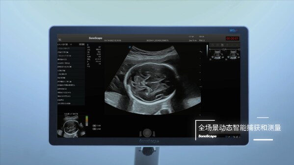 開(kāi)立醫(yī)療獲得國(guó)內(nèi)首個(gè)產(chǎn)前超聲人工智能醫(yī)療器械證