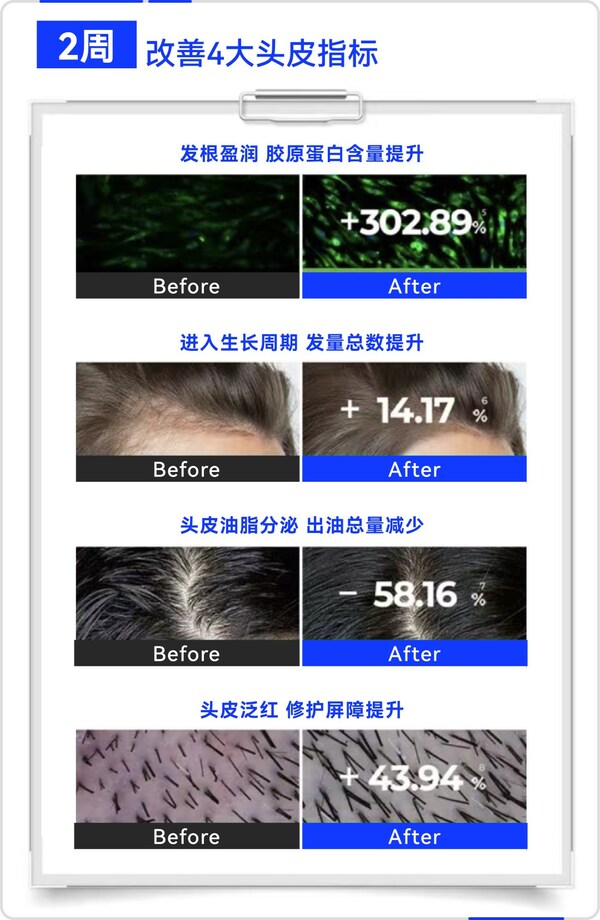 晶泰科技AI 研發(fā)平臺開發(fā)的小分子Remeanagen? 和多肽 AquaKine?聯(lián)用配方改善頭皮四大指標(biāo)，有效固發(fā)防掉發(fā)